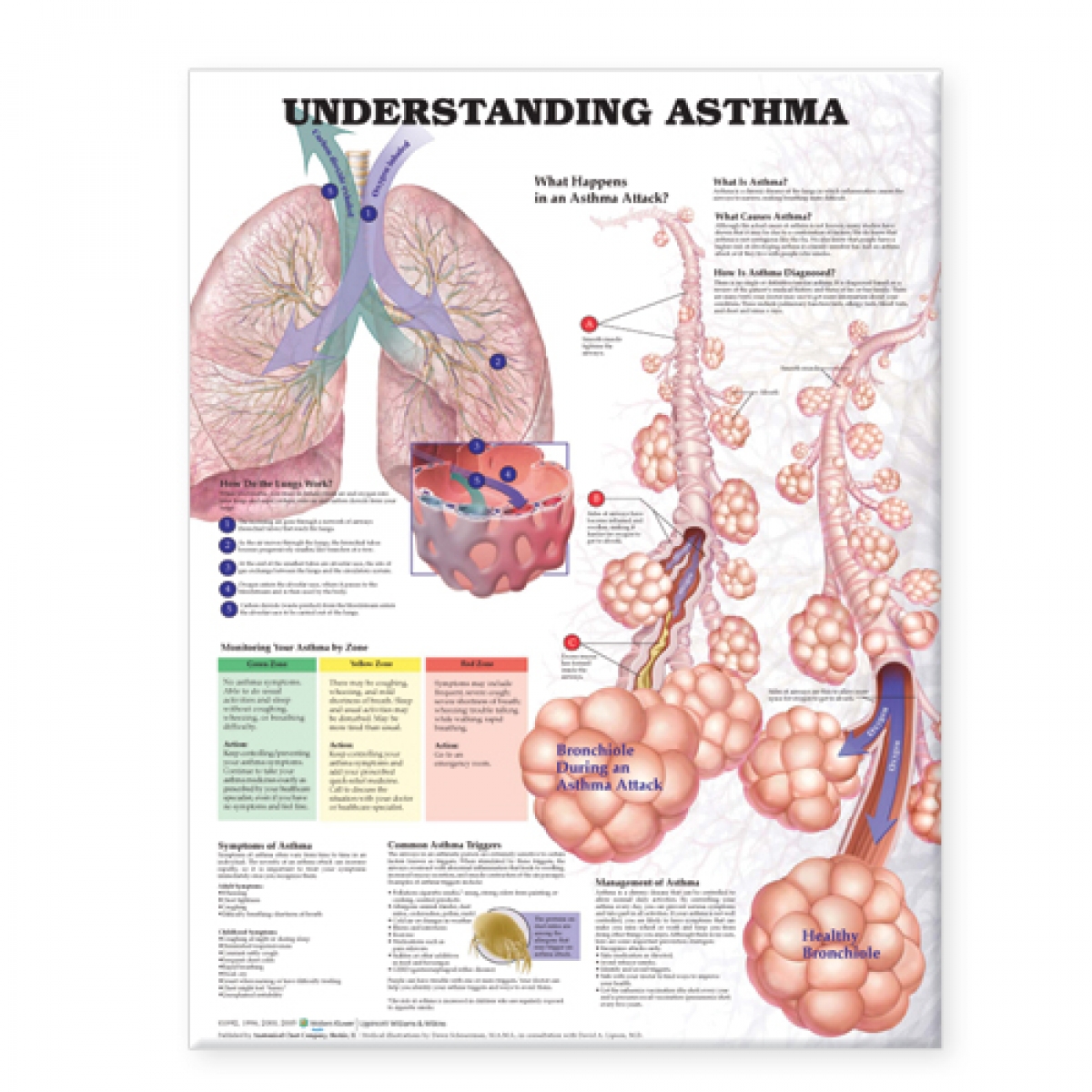 Understanding Asthma Chart (52x70cm) With Special Rigid Lamination and